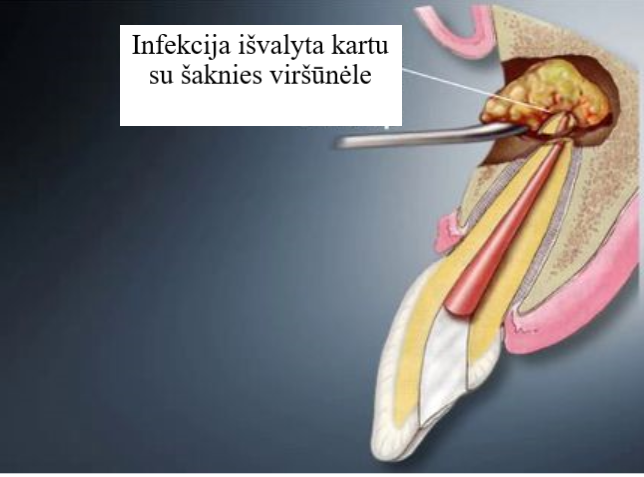 Danties šaknies rezekcijos procedūra